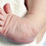 With treatment 95% can walk run and move