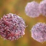WCD: Nigeria has no comprehensive cancer centre, albinism battling cancer, cancer care disparities, Cancer deaths among men expected to rise 94 percent worldwide by 2050 —Study