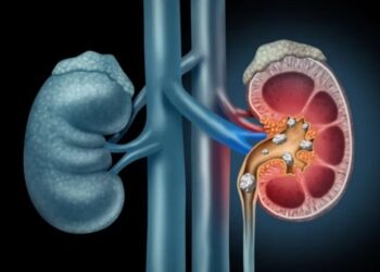 Living with one kidney Are my kidneys fine? 10 essential steps to prevent kidney damage