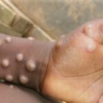 Monkey pox, Monkeypox confirmed in Calabar, Monkeypox case confirmed First Monkeypox case , Symptoms of monkeypox