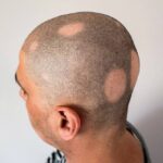 Hair loss (alopecia), alopecia