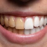 yellow stains on your teeth