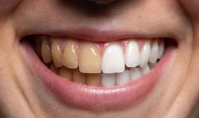 yellow stains on your teeth