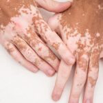 Causes and treatments of vitiligo