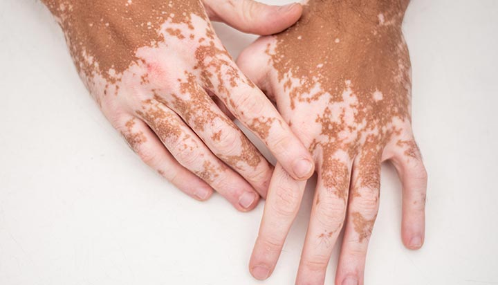 Causes and treatments of vitiligo