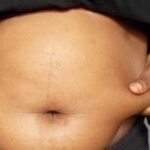 Causes of Potbelly