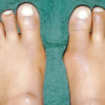 What are bunions