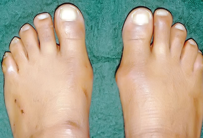 What are bunions