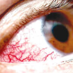 Nine dead in new outbreak of ‘eye-bleeding’ virus