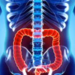 Colon cancer is common but curable