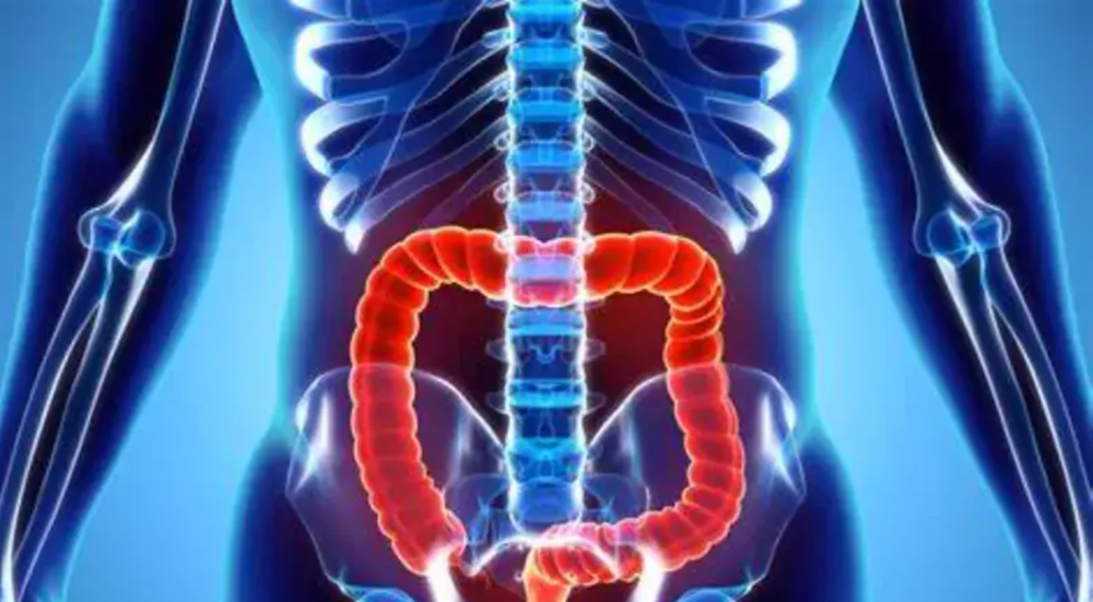 Colon cancer is common but curable