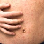 Measles US second death