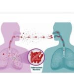 Tuberculosis awareness campaign