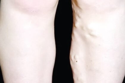 Are these varicose veins