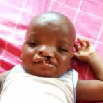 Foundation offers free cleft, craniofacial surgery to 40 beneficiaries in FCT