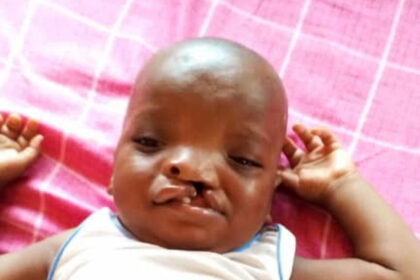 Foundation offers free cleft, craniofacial surgery to 40 beneficiaries in FCT