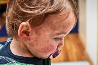 US measles cases top 1,000 for first time in five years