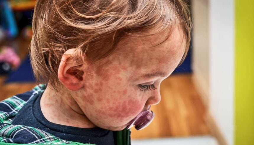 US measles cases top 1,000 for first time in five years