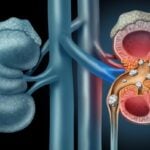 What causes kidney stones?