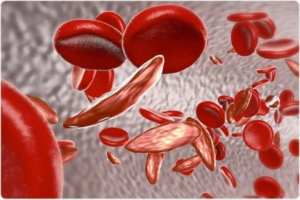 Sickle cell screening