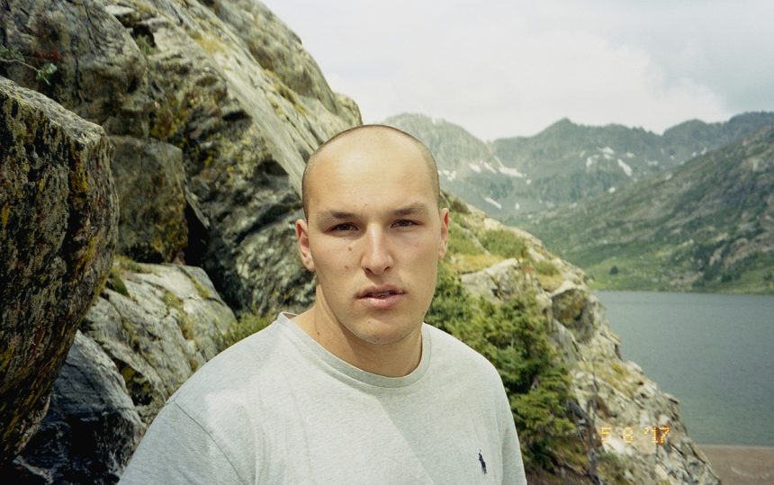 Receding Hairline