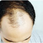 bald hair