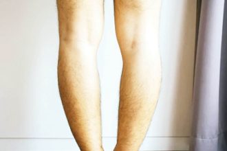 Bow legs at