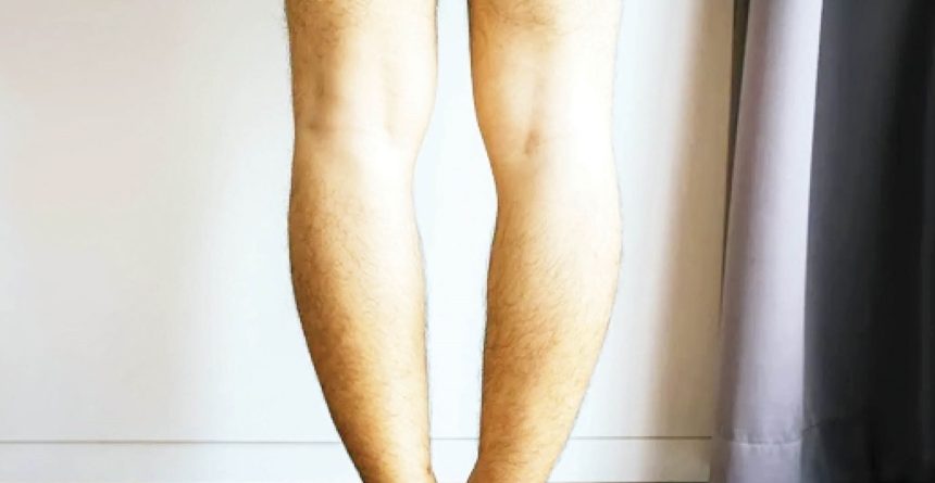 Bow legs at