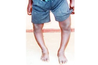 bow legs