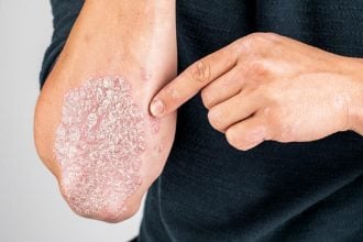 psoriasis