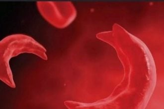 sickle cell