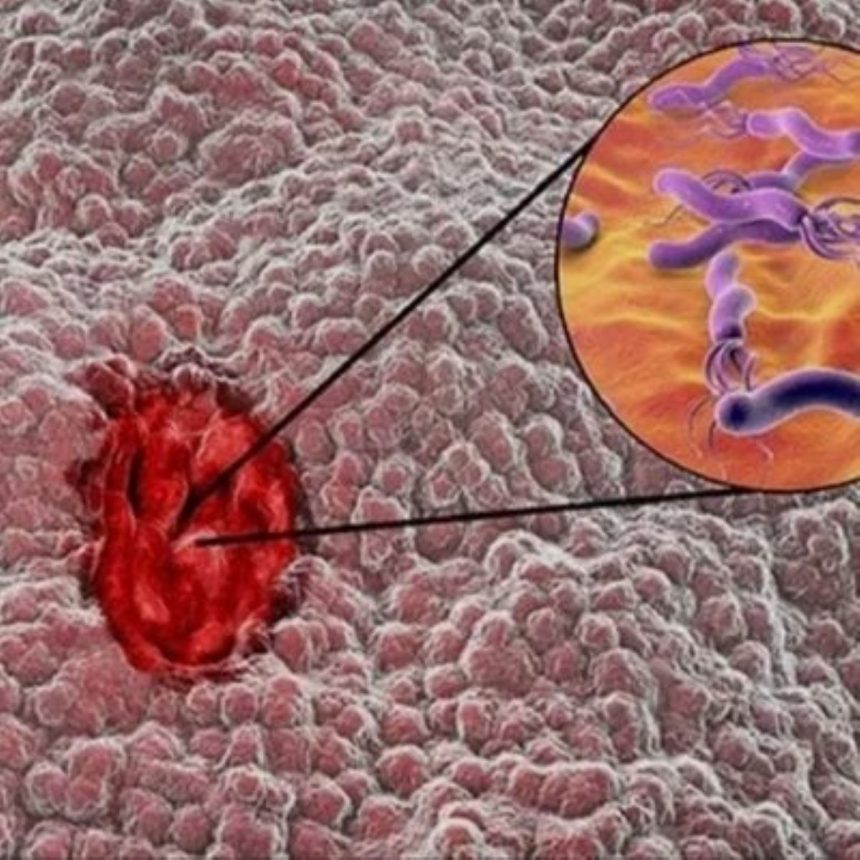 stomach ulcer