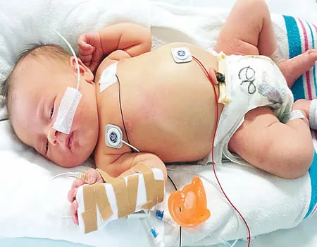 Infants can also suffer stroke