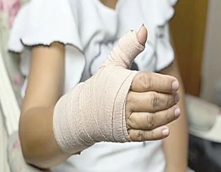 Fracture