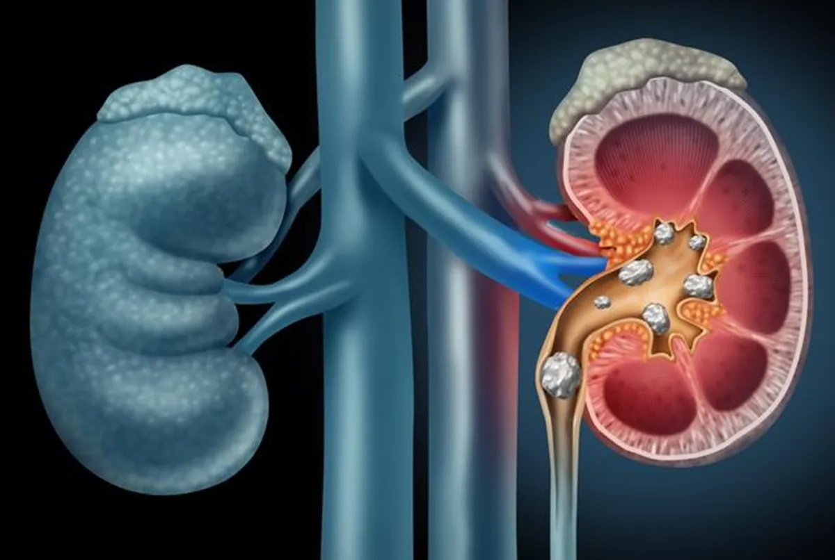 What causes kidney stones?